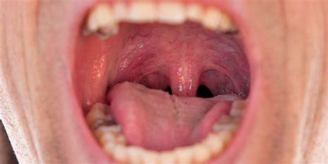 Sore throat remedies: what really works? - Which?