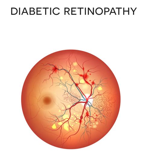 Diabetic Retinopathy - Retina Vitreous Consultants, Inc