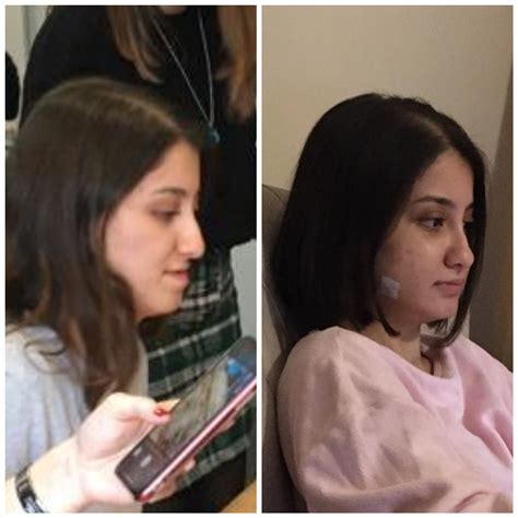 Double jaw surgery has changed my whole face. I could have never