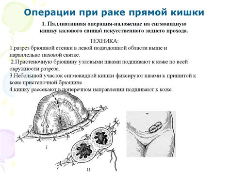 Операции на прямой кишке - презентация онлайн
