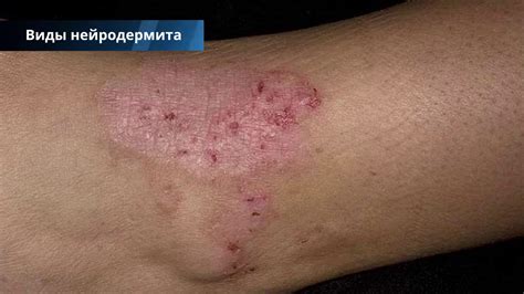 Нейродермит у детей и взрослых на голове, лице, ногах - лечение ...