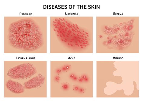 How to tell the difference between eczema and psoriasis, so you can get ...
