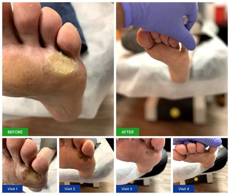 Plantar Wart Treatment - New Horizons Foot and Ankle Associates