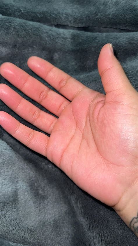 Burning pain in hands : r/medical_advice