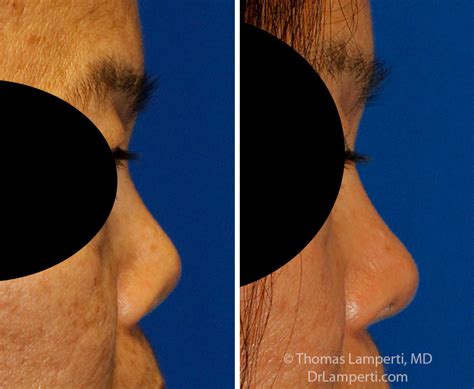 upturned nose male