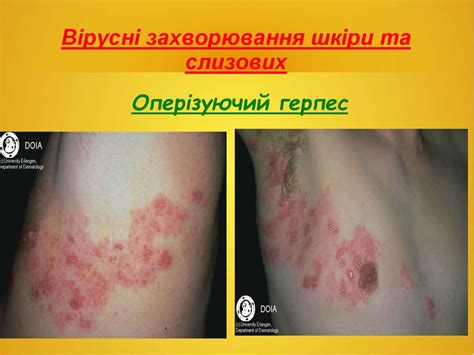 Піодермії. Дерматомікози. Дерматозоонози. Вірусні дерматози ...