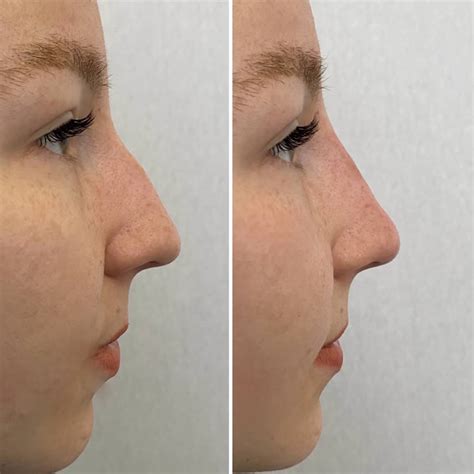 dermal fillers didcot dental studio