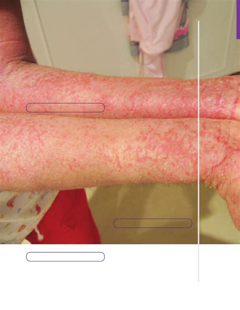 Dermatitis and eczema Notes: Diagrams & Illustrations | Osmosis