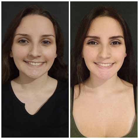 1 day before surgery vs 8 months after surgery : r/jawsurgery
