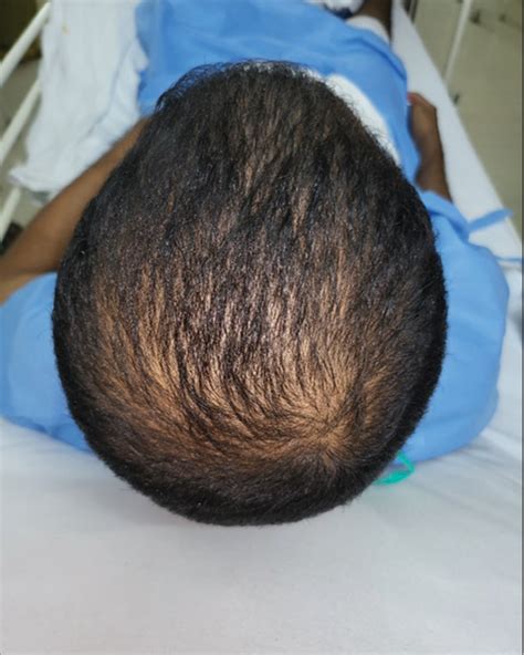 guidelines based management  androgenetic alopecia cosmoderma