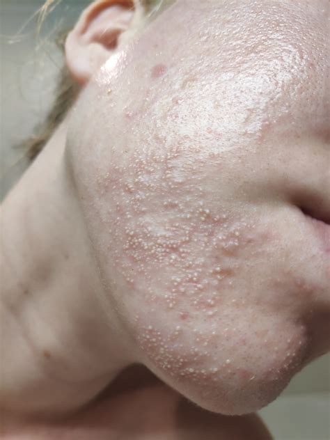 Fungal Acne Vs Milia at Oscar Trundle blog