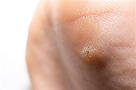 Viral Warts in Mumbai | Viral Warts Treatment