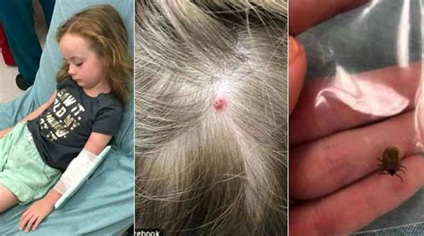 Carrapato Na Cabeça De Criança - Menina de 5 anos fica paralisada após mordida de carrapato e mãe alerta