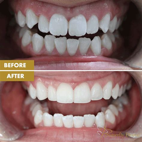Composite Bonding Treatment | Award Winning Manchester Dentist