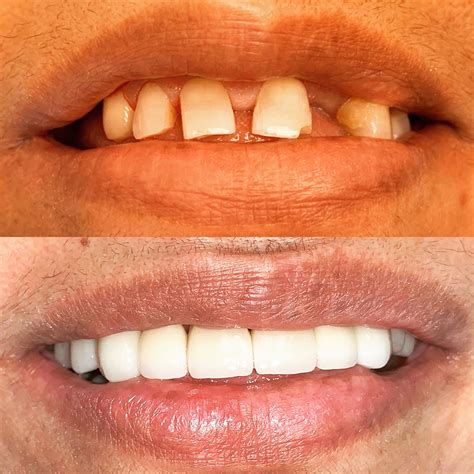 Veneers Teeth Miami at Michelle Burgess blog