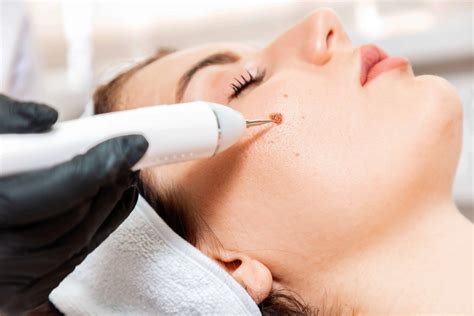 How Long Does Mole Removal Take? Step-by-Step Guide