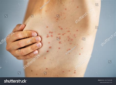 Woman Body Skin Rash Red Allergy Stock Photo 2217325109 | Shutterstock