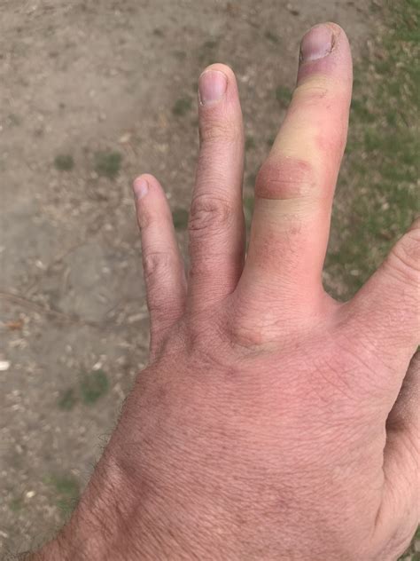 Red Wasp Sting Swelling Wasp Sting | Here's What You Need To Know!