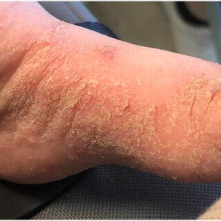 Crusted scabies in an immunocompromised patient. | Download Scientific ...