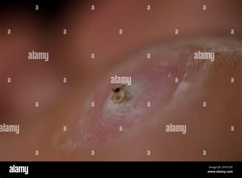 skin wart bottom   foot plantar wart stock photo alamy