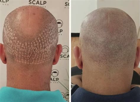 Hair Transplant Scar Tattoos