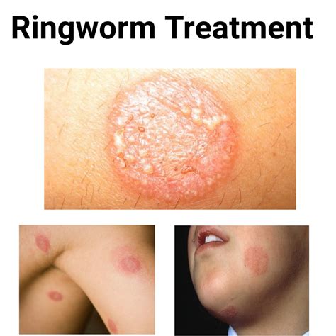 ringworm diagnosis treatment  prevention geye