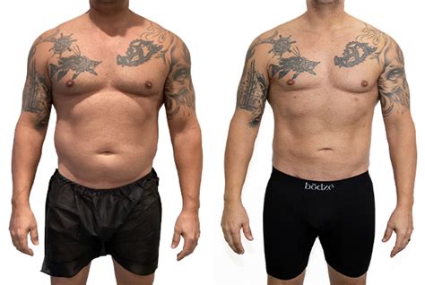 mens liposuction   dr miles  bodze