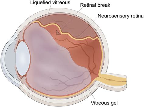 The schematic diagram of rhegmatogenous retinal detachment. The ...
