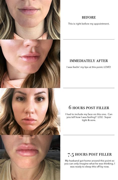 Juvederm Lips Before And After 1 Syringe at Neida Tracy blog