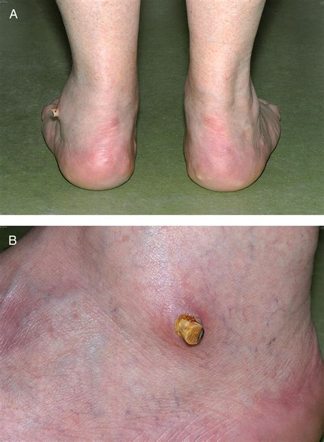 Arthroereisis of the Subtalar Joint: An Uncommon Complication and ...