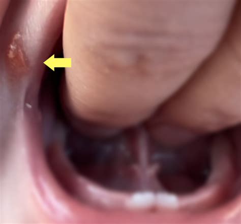 how to know if you have a tongue tie