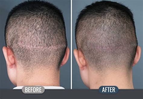 Hair Transplant Scar Removal | My Hair Transplant Clinics