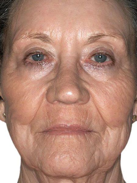 ultrapulse laser skin resurfacing dr nyla