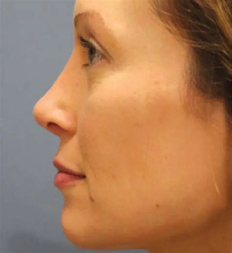 Rhinoplasty