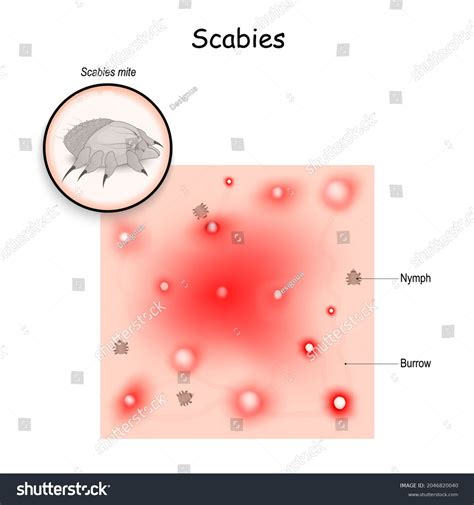 340 Itch mite Stock Vectors, Images & Vector Art | Shutterstock