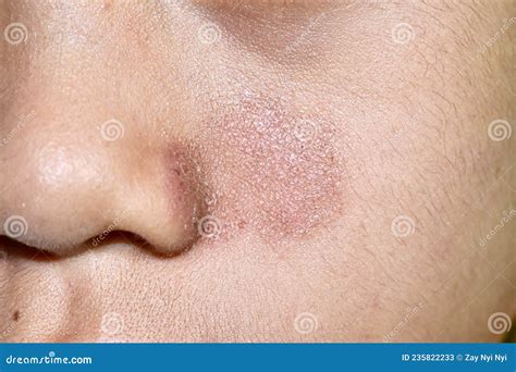 Fungal Infection On Face Of Baby at Robert Parsley blog