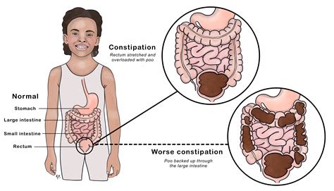 Constipation: Symptoms, Causes, and Home Remedies - homeopathy360