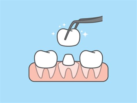 Restore Your Smile With Custom Dental Crowns | Audubon, IA