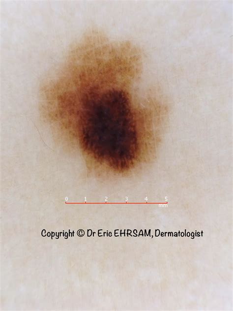 dermoscopy: Asymmetric pigmented lesion on a leg