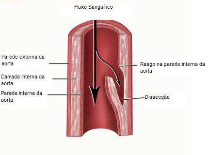 O Que É Dissecção Da Aorta - Dissecção de Aorta