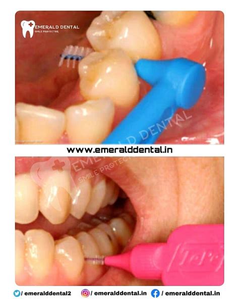 INTERPROXIMAL BRUSH - EMERALD DENTAL