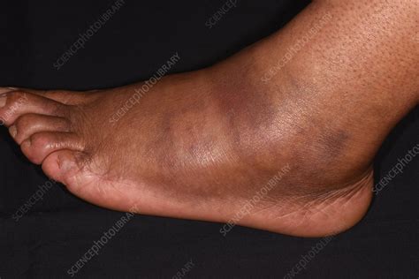 how to fix a fractured foot