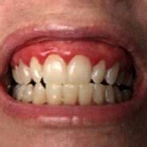 initial aspect  gingival mucosa  mucosa  presenting signals