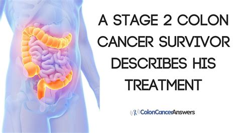 Stage 2 Colon Cancer Survivor Describes His Treatment - YouTube