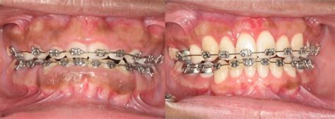 how to fix gums growing over braces