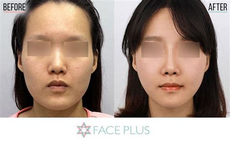 Chin Reduction – Face Plus Clinic Korea