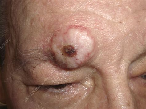 Squamous cell carcinoma on a man's forehead - Stock Image - C058/3074 ...