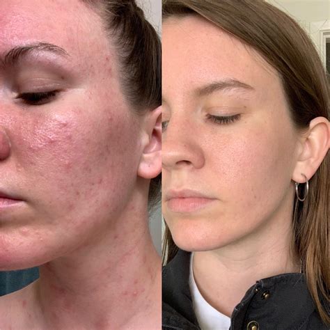 dermatitis in face 8