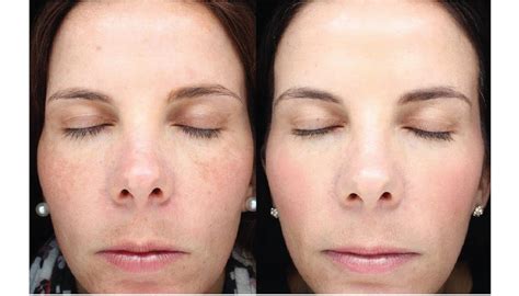 Halo Laser Resurfacing Before & After Photos | Face Forward Medical ...