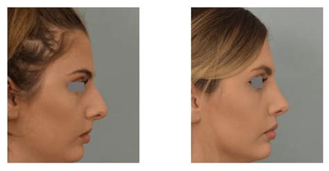 The Best Rhinoplasty Surgeons in Los Angeles - My Beauty Consultant